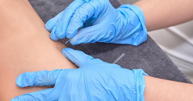Dry Needling